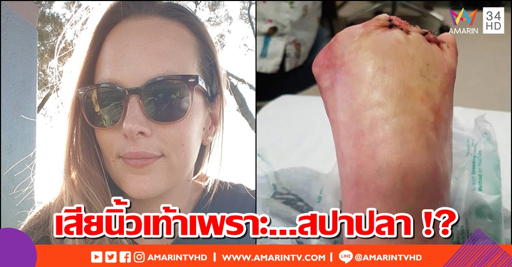 สาวออสซี่ อ้าง 'สปาปลา' เมืองไทยทำเท้าเน่าถึงกระดูก จนต้องตัดนิ้วทิ้ง