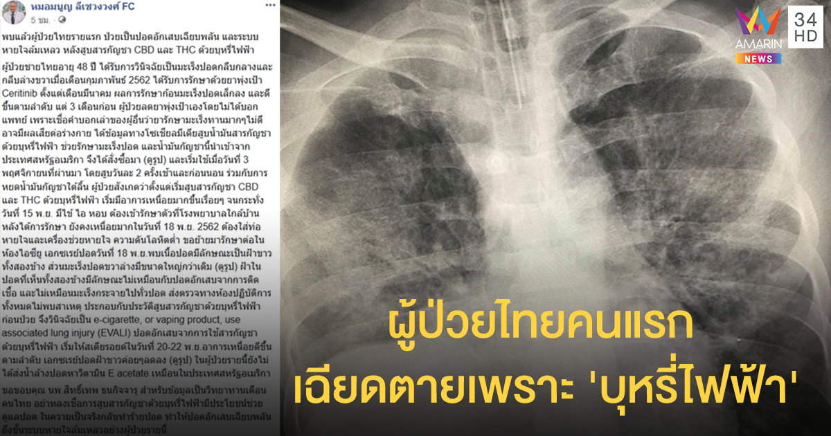 รายแรกของไทย ผู้ป่วยปอดอักเสบเฉียบพลัน-ระบบหัวใจล้มเหลว พบประวัติใช้ 'น้ำมันกัญชาด้วยบุหรี่ไฟฟ้า' ก่อนหน้า