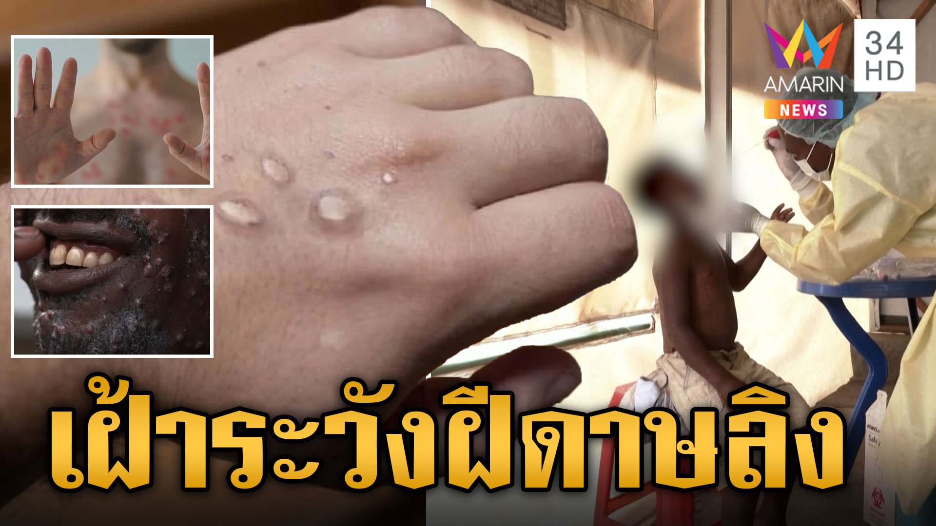 จับตาฝีดาษลิง สายพันธุ์ Clade 1 หมอแนะทางป้องกัน | ข่าวเย็นอมรินทร์ | 21 ส.ค. 67 | AMARIN TVHD34