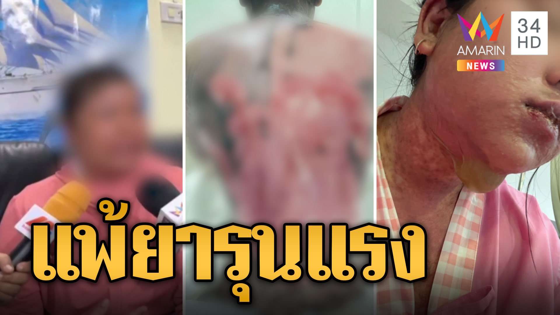 สาวแพ้ยาหนักหวิดเสียโฉม หนังหลุดเห็นเนื้อแดงทั้งหลัง | ข่าวเที่ยงอมรินทร์ | 5 ก.พ. 67 | AMARIN TVHD34