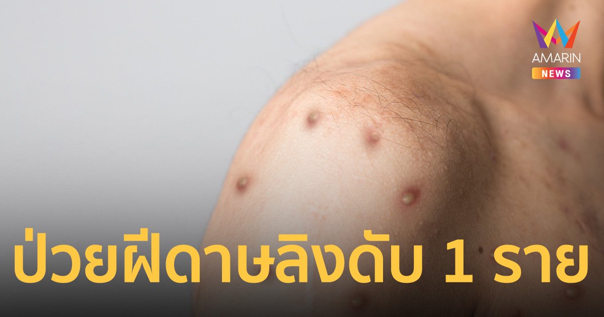ฝีดาษลิง - พบผู้ป่วยเสียชีวิตรายแรกในไทย ติดเชื้อ HIV และ ซิฟิลิสร่วม