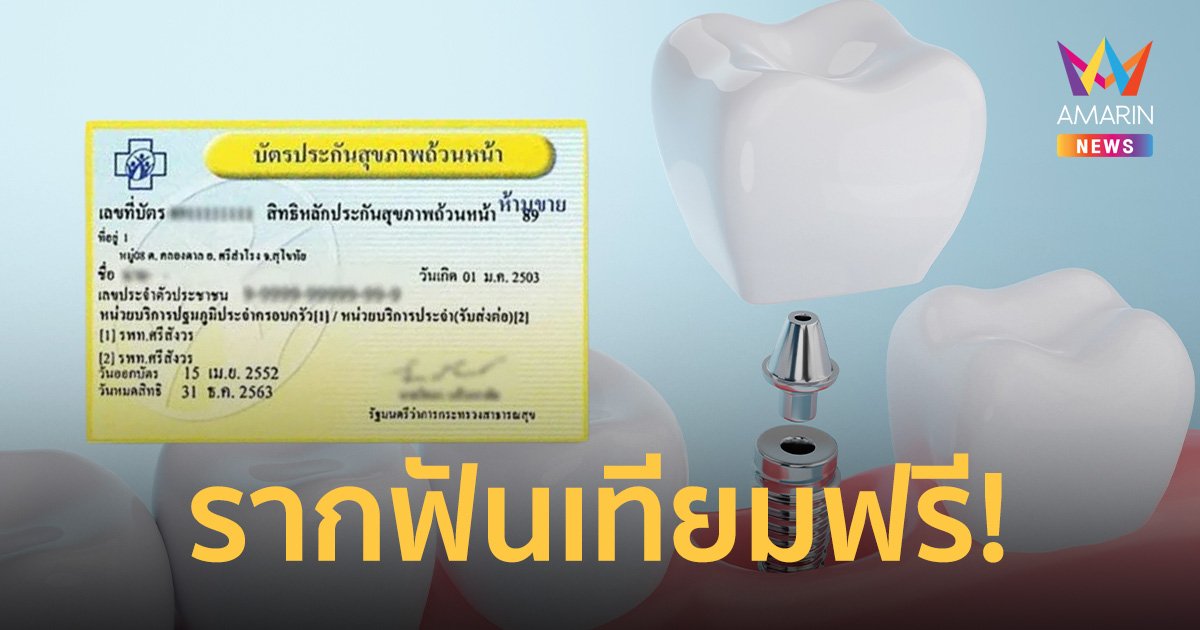 ข่าวดี! บัตรทองใช้สิทธิรักษา ใส่รากฟันเทียมฟรี ถึง 30 ก.ย. 67