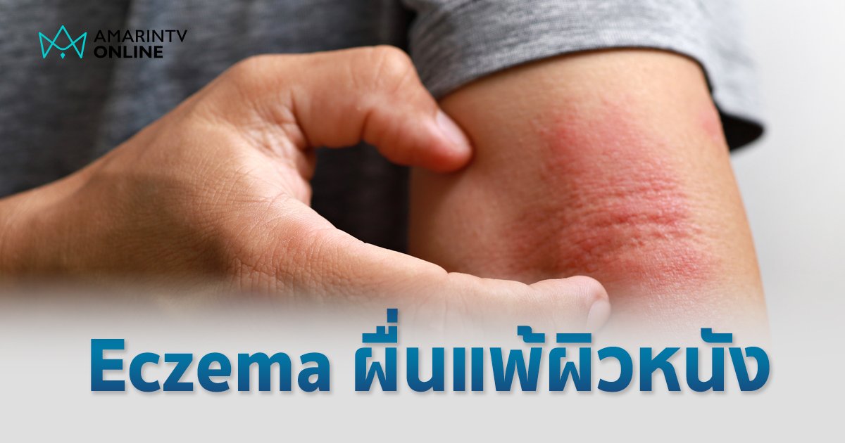 รู้ทันโรค Eczema ผื่นแพ้ผิวหนัง อย่าชะล่าใจหากมีผื่นแดงขึ้น