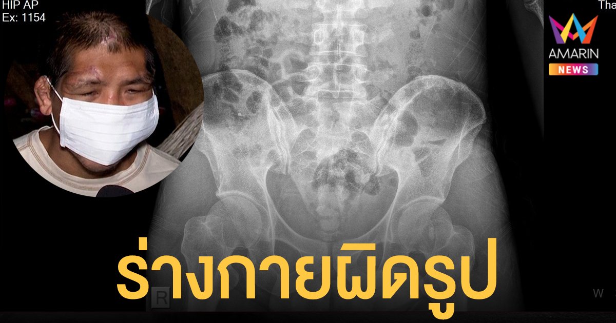 ทนายเกิดผล เผยภาพ  X-Ray ฟ้า การเชื่อมต่อกระดูกผิดพลาด ร่างกายผิดรูป