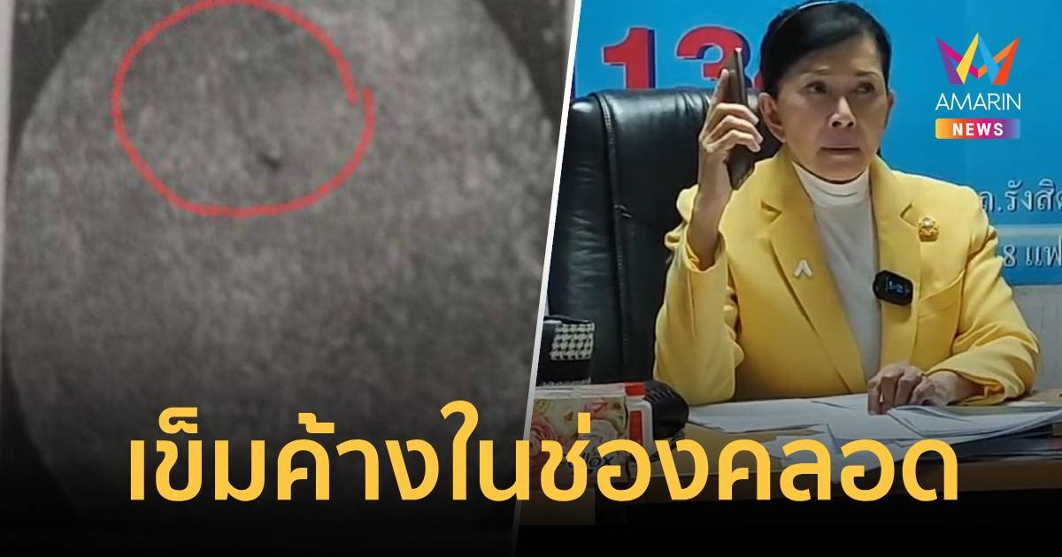 สาวร้องพยาบาลทำเข็มหล่นในช่องคลอด ทนทุกข์ 18 ปี ยังเอาออกไม่ได้