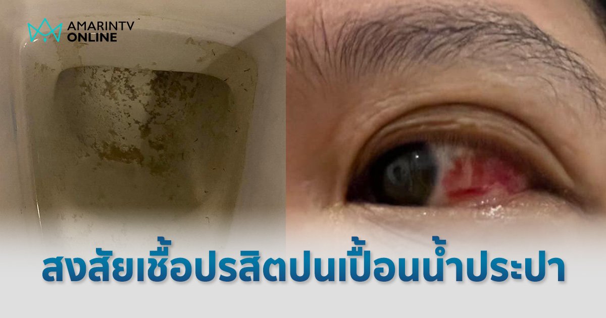 ลูกบ้านคอนโดหรูป่วยติดเชื้อนับ 100 ราย สงสัย "เชื้อปรสิต" ปนเปื้อนในน้ำประปา 