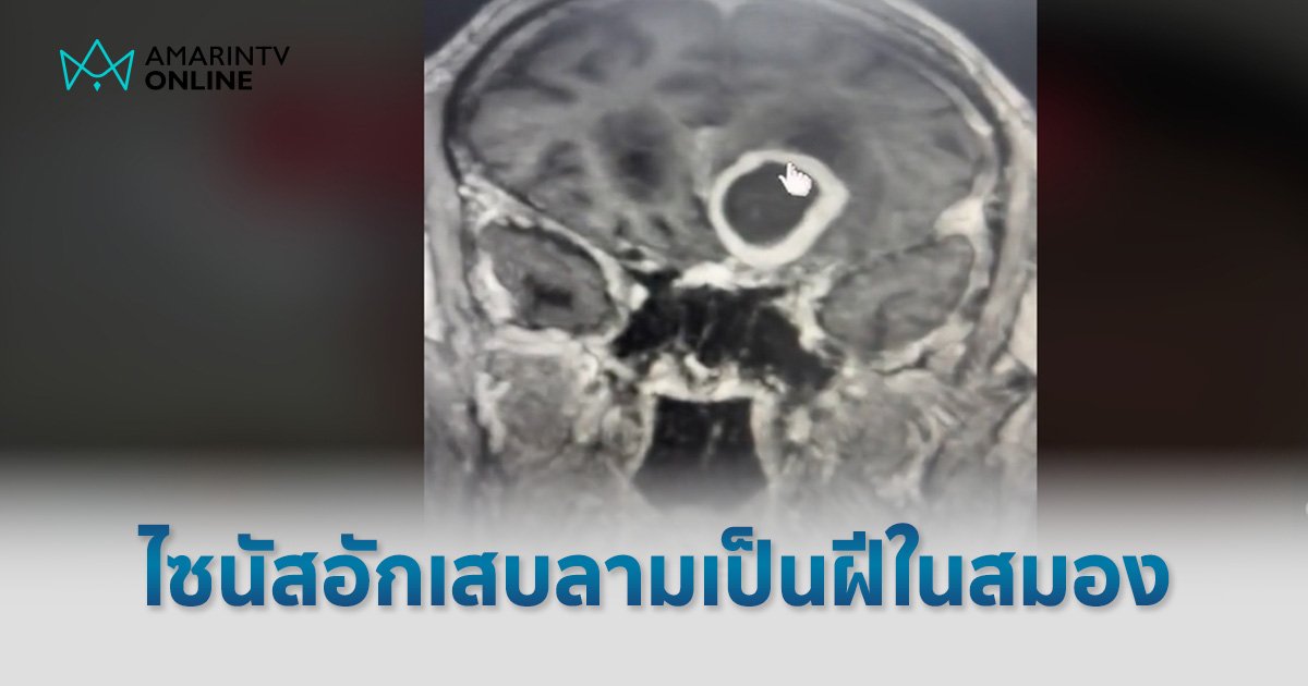 "ไซนัสอักเสบ" ลามเป็น "ฝีในสมอง" หมอเตือน 3 อาการป่วย หากติดเชื้อลามขึ้นสมองได้ 