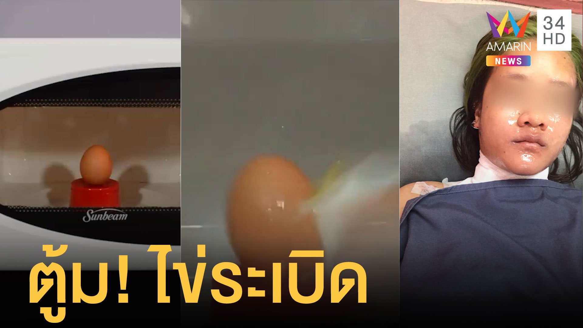 เตือนภัย ต้มไข่ในไมโครเวฟ ระเบิดใส่หน้าสาวเละ | ข่าวอรุณอมรินทร์ | 3 ส.ค. 63 | AMARIN TVHD34