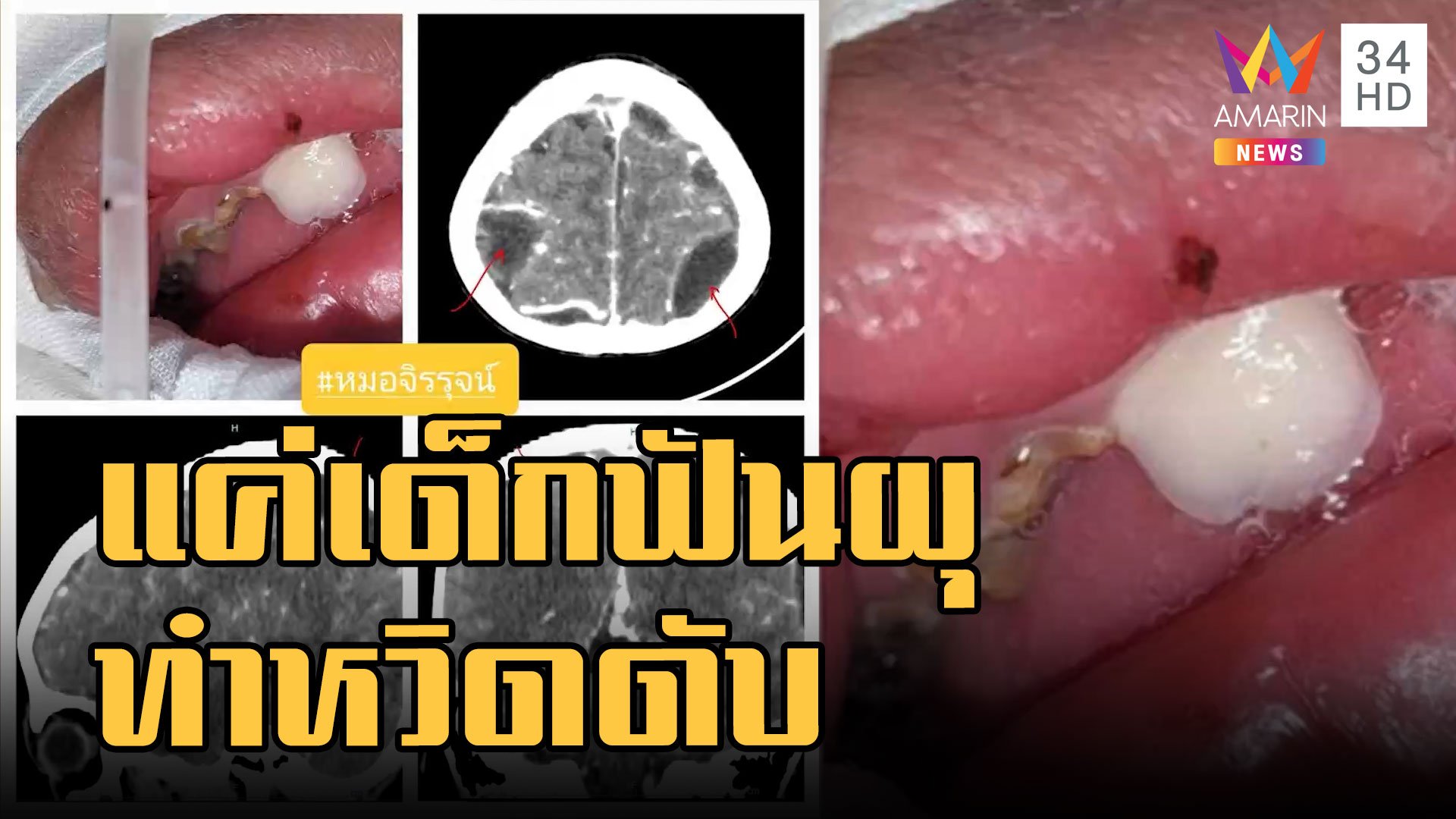 หนูน้อยฟันผุ หนองขึ้นสมองหามส่ง ICU หวิดดับ | ข่าวเที่ยงอมรินทร์ | 21 ม.ค. 66 | AMARIN TVHD34