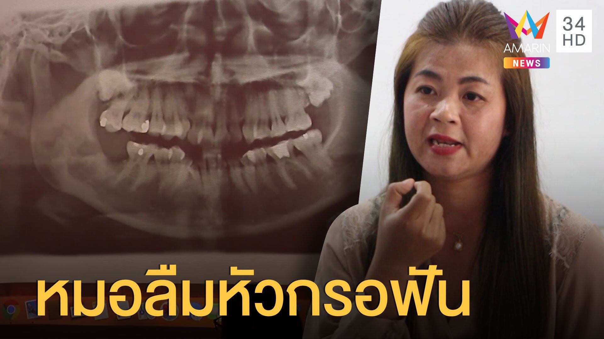 หมอลืมหัวกรอฟันไว้ในปาก 5 ปีเต็ม กระทบชีวิตหนัก | ข่าวอรุณอมรินทร์ | 18 ส.ค. 63 | AMARIN TVHD34