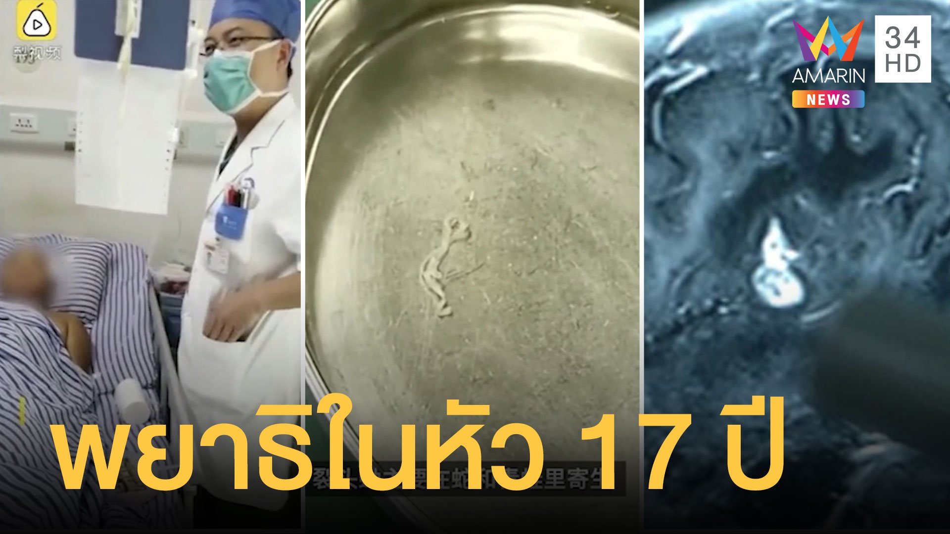  สยอง พยาธิตัวตืดเลี้อยในสมอง พบอาศัยอยู่ในตัวมานาน 17 ปี | ข่าวอรุณอมรินทร์ | 30 ส.ค. 63 | AMARIN TVHD34