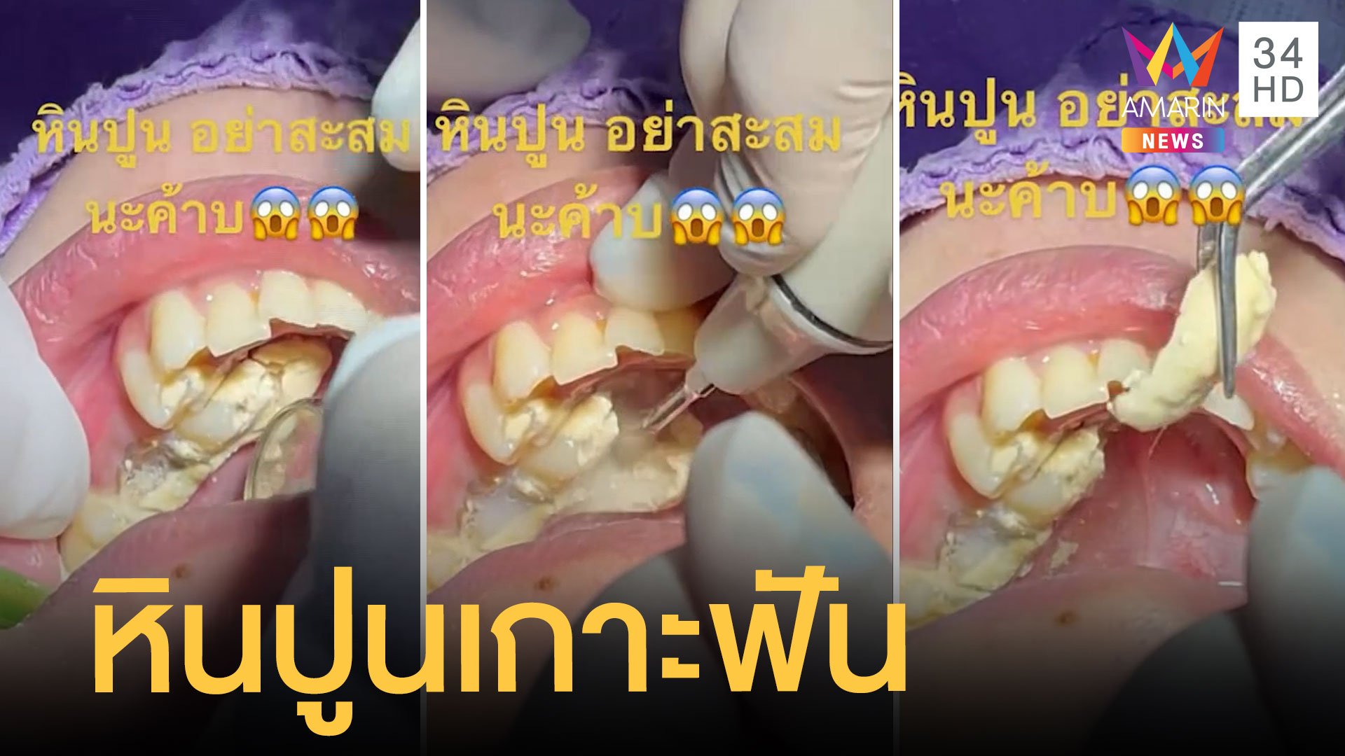 หมอฟันโพสต์คลิปหินปูนเกาะฟันหนามาก | ข่าวอรุณอมรินทร์ | 20 ม.ค. 65 | AMARIN TVHD34