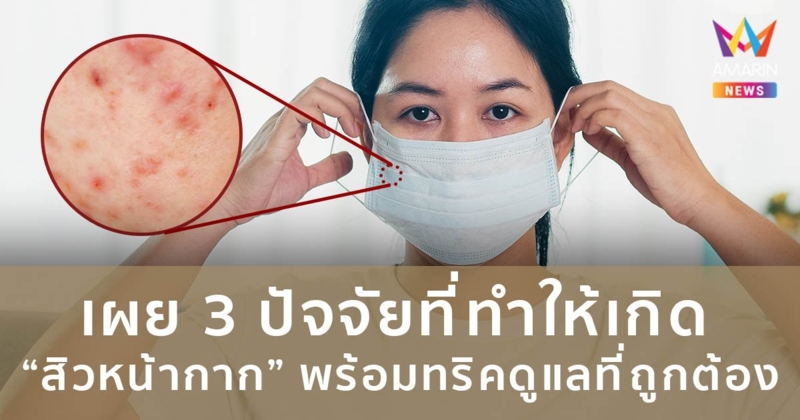 เผย 3 ปัจจัยที่ทำให้เกิด “สิวหน้ากาก” พร้อมทริคดูแลที่ถูกต้อง