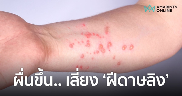 อาจเสี่ยงเป็น "ฝีดาษลิง" ผื่นขึ้นตามตัว.. อย่ามองข้าม!