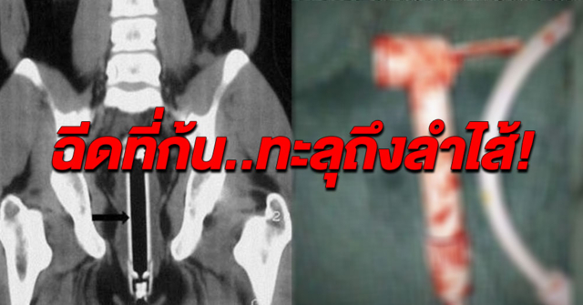 อยากหลอกหมอนะ! หนุ่มอินเดียอ้างลื่นล้มทับ 'ที่ฉีดตูด' ผลุบเข้าก้นทะลุถึงลำไส้