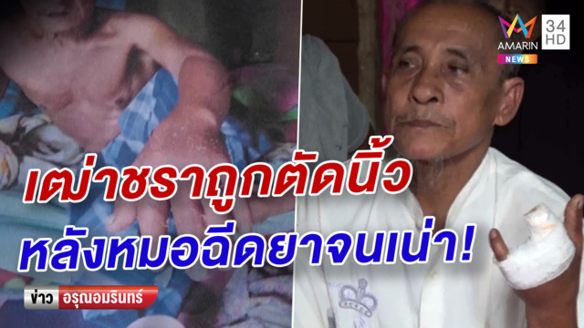 ชายชราสตูล ครวญ ถูกตัดนิ้วมือหลังหมอฉีดยาเข้าง่ามนิ้วจนเน่า (คลิป)