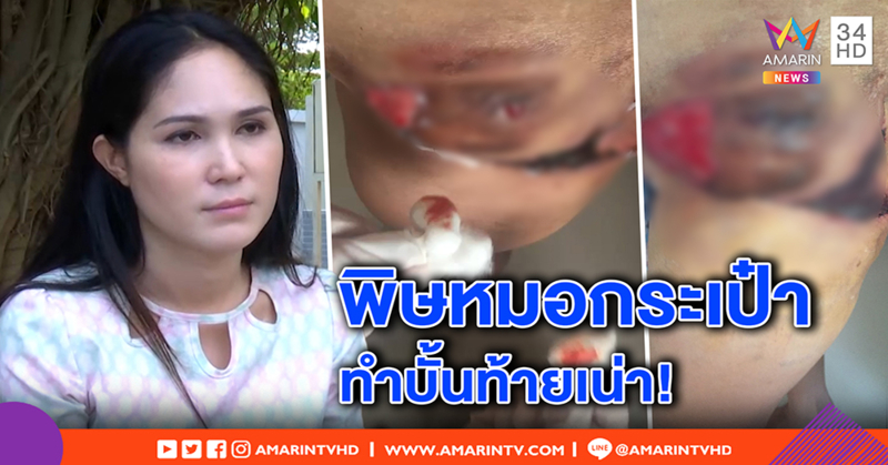 เปิดใจ! สาวสองเข็ดฉีดเสริมสะโพกเน่า ทน 6 ปี ผ่าตัดเนื้อทิ้ง ลั่นเอาผิดหมอกระเป๋า (คลิป)