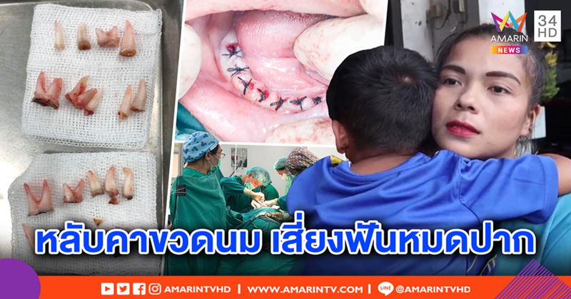 แม่รับผิด หมอถอนฟันลูก 4 ขวบ 18 ซี่ เหตุปล่อยขวดนมคาปาก ตามใจจนฟันผุ (คลิป)
