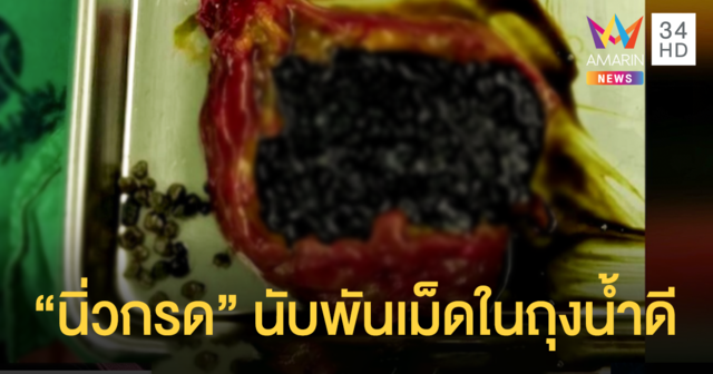 หมออึ้ง! เจอ 