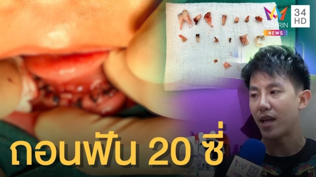 อุทาหรณ์! เด็ก 4 ขวบ ฟันน้ำนมผุลุกลาม หมอถอน 20 ซี่ (คลิป)