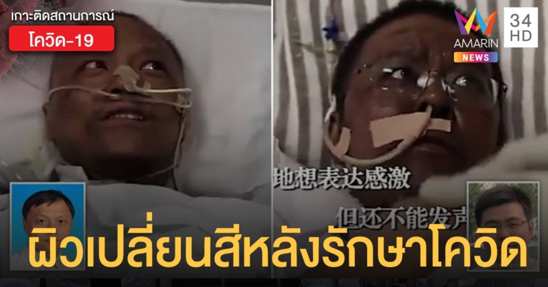 แพทย์จีนผิวเปลี่ยนสี  ตับเสียหายจากรักษาโควิด-19