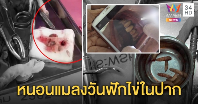 หมอฟันสุดอึ้งนึกว่ามีแต่ในตำรา พบรังหนอนแมลงวันเต็มปากผู้ป่วยติดเตียง ผ่าเจอ 15 ตัว (คลิป)