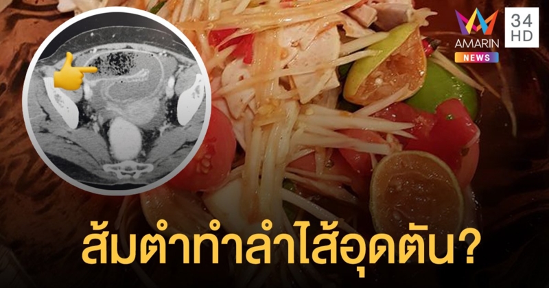 หมอโพสต์เตือน คนไข้กินส้มตำโดยไม่เคี้ยว ทำลำไส้อุดตัน