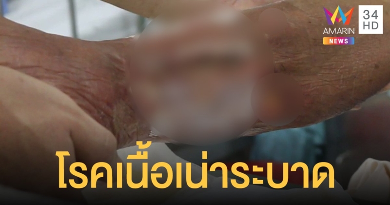 โรคเนื้อเน่าระบาด แพทย์เตือน "เกษตรกร" กลุ่มเสี่ยง เป็นแล้วไม่รีบรักษา ติดเชื้อถึงตาย
