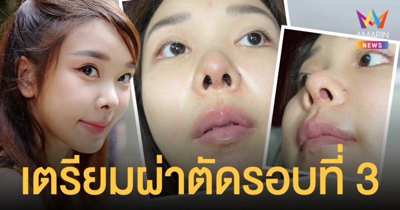 ยังไม่จบ!  หญิงแย้  นนทพร  เตรียมผ่าตัดรอบที่ 3 เอากระดูกอ่อนหลังหูที่เหลือไว้ออก!