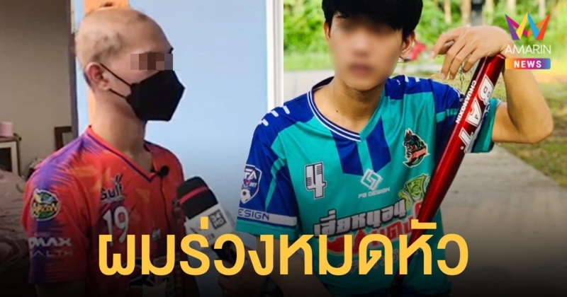 หนุ่ม ปวส.ปี 1 ช็อก! ฉีดวัคซีน ซิโนแวค เข็ม 2 แล้วผมร่วงหมดหัว