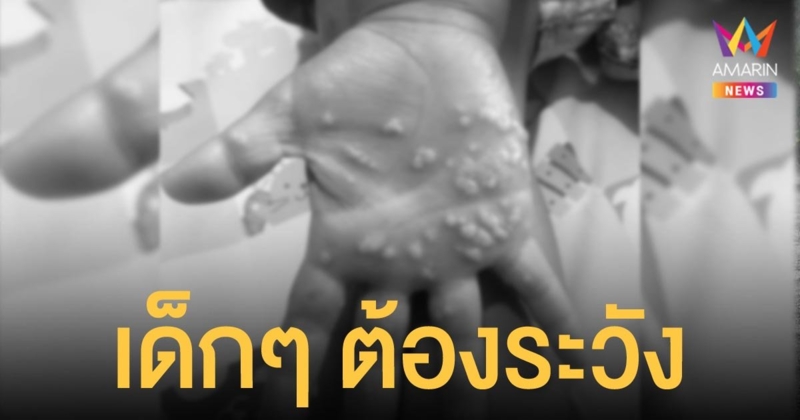 หมอเตือนคนมีลูกเล็ก ต้องระวังปล่อยให้เล่นดินทราย ติดเชื้อแบคทีเรีย จนมือเป็นหนอง