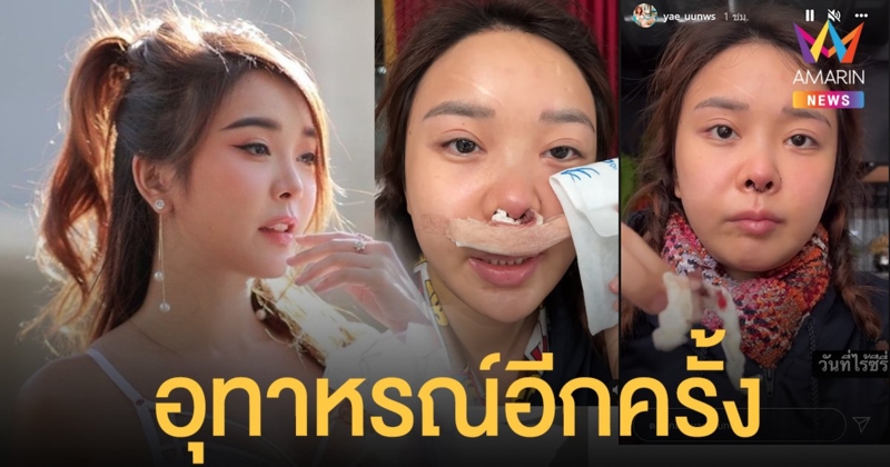 ในวันที่ไร้ซิลิโคน! หญิงแย้ โชว์จมูกดั้งเดิม เผยอุทาหรณ์หลังทำศัลยกรรมรอบล่าสุด