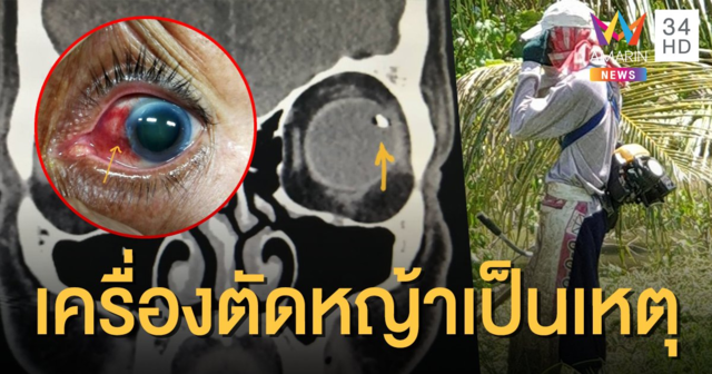 อุทาหรณ์! ตัดหญ้าสะพายไหล่ ใบมีดกระทบหิน-เศษพุ่งทะลุดวงตา