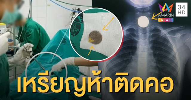 อุทาหรณ์พ่อแม่! เด็ก 6 ขวบ กลืนเหรียญ 5 บาทติดคอ หวิดอุดหลอดลมเสียชีวิต