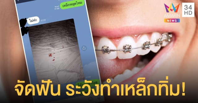 คลินิกทำฟัน แชร์ประสบการณ์สยิวสาว จัดฟัน ทำเหล็กทิ่ม!