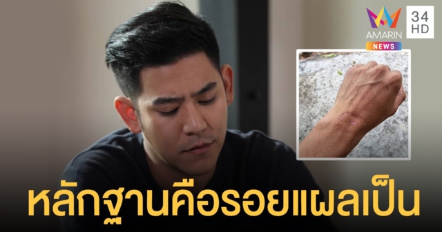 พอร์ช ศรัณย์ โชว์หลักฐานรอยแผลเป็น ลั่นแฮชแท็กกระตุกต่อมเผือก #ความจริงเมื่อปีที่แล้ว