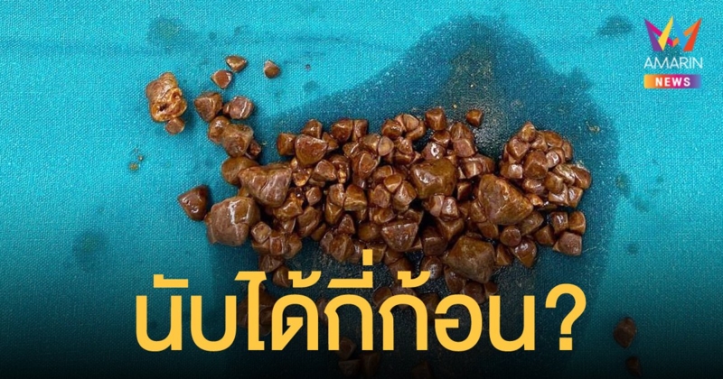 ตะลึง หมอเจอนิ่วในถุงน้ำดี นับร้อยก้อน เตือนหากมีไข้ ปวดท้อง ต้องรีบรักษา