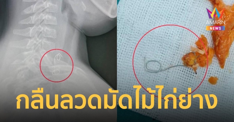 อุทาหรณ์! เด็ก 8 ขวบกลืนลวดมัดไม้ไก่ย่าง ยาว 8 ซม. ฝังในผนังหลอดอาหาร