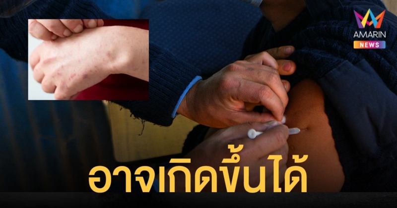 แพทย์ผิวหนังชี้ โรคตุ่มน้ำพองใส อาจเกิดขึ้นได้หลังฉีด วัคซีน โควิด