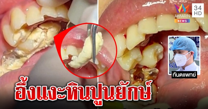 สยอง! หินปูนก้อนโตเกาะฟันนานนับปี หมอเหงื่อตกเคลียร์ 1 ชั่วโมง เผยพบบ่อยในคนชายขอบ (คลิป)