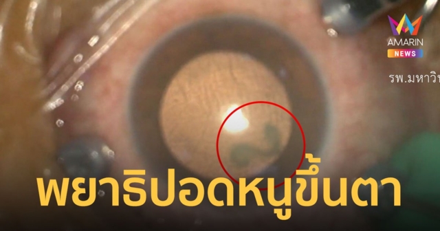 หญิงตาบอด หลัง พยาธิปอดหนูขึ้นตา เหตุชอบกินอาหารสุกๆ ดิบๆ