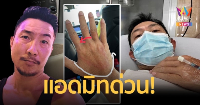 โจอี้ บอย  แอดมิทด่วน! ถูกแตนต่อยเกิดอาการแพ้รุนแรง - ลมพิษขึ้น