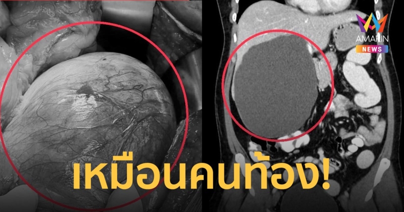 ช็อก! ผู้ป่วยท้องอืดกว่าปี ตรวจอีกทีเจอก้อนถุงน้ำในตับขนาด  20 ซม.