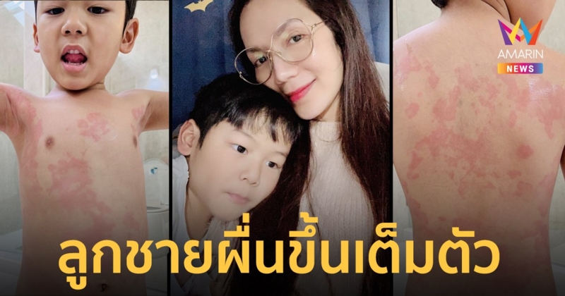 “อ๋อม สกาวใจ” สงสารลูกชาย “น้องจอมทัพ” ผื่นขึ้นเต็มตัว ไม่รู้ไปโดนอะไรมา!