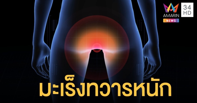 รู้จัก "มะเร็งทวารหนัก" โอกาสเสียชีวิตสูง