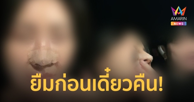 รักกันต้องให้ได้! สาวเสริมจมูก กระดูกหลังหูตัวเองหมด ขอยืมของแฟนหนุ่มมาใช้ก่อน