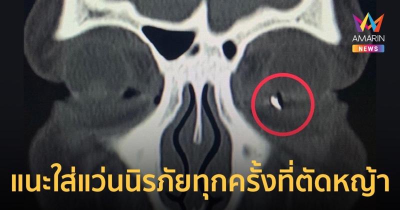 หมอโพสต์เตือน หลังพบใบมีดตัดหญ้าแตกเข้าตาคนไข้ แนะต้องใส่แว่นป้องกัน
