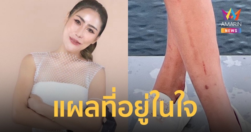 สาวเล่าแพ้ “ครีมกำจัดขน” รุนแรง จนเกิดแผลในใจ ไม่เคยใส่ขาสั้นอีกเลย