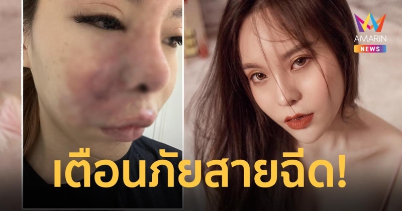 "น้องมะลิ"แชร์ประสบการณ์ ฉีดฟิลเลอร์เข้าเส้นเลือดจนเสียโฉมหวิดตาบอด