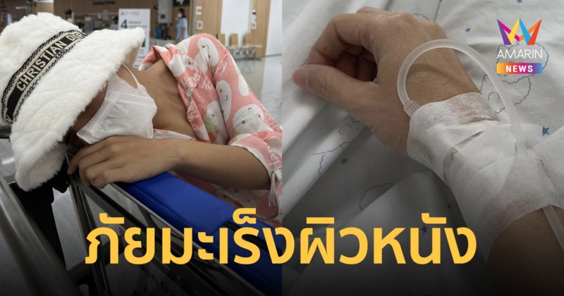 สาววัย 27 เป็นมะเร็งผิวหนังระยะ 3 ลามไปถึงกระดูก ชี้เป็นภัยใกล้ตัวแข็งแรงมาตลอดก็ป่วยได้
